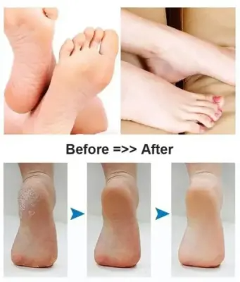 Rechargeable Pedicure Machine – Foot & Heel Care Device with 2 Roller Heads for Smooth, Soft Feet